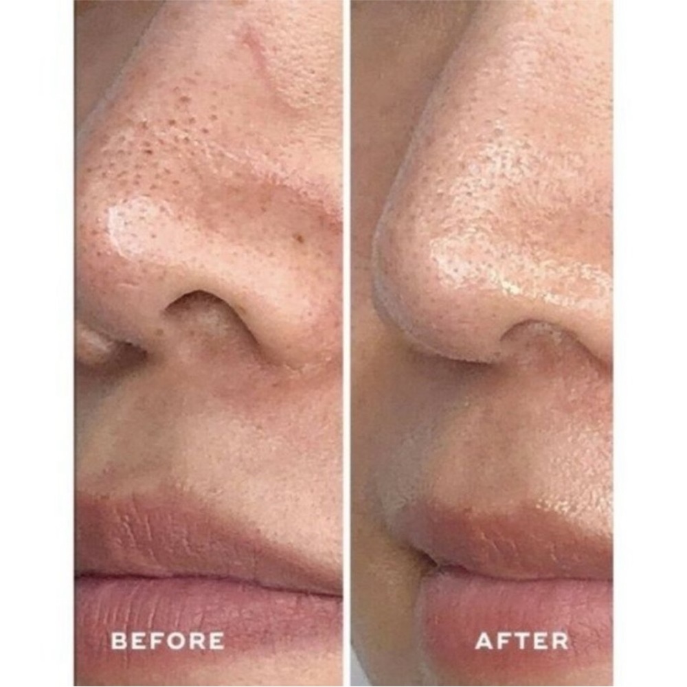 ACEOLOGY Detoxifying Treatment Mask - Picture 5 of 9